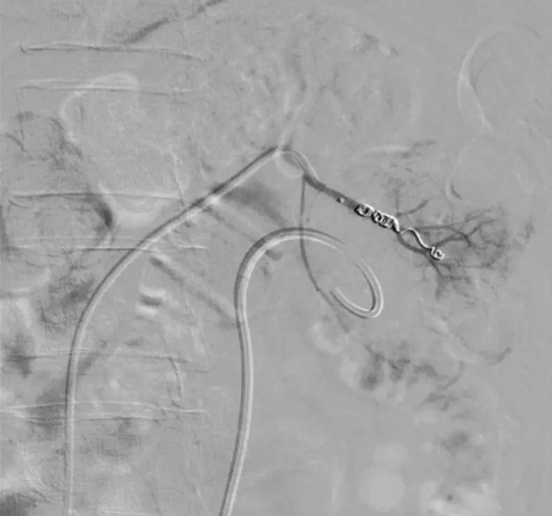 TRIHMS performs first-ever RI treatment of renal artery pseudoaneurysm